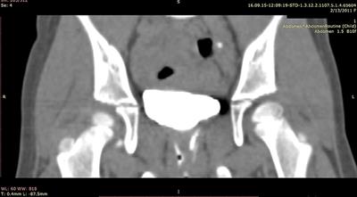 A Rare Case of Double-System With Ectopic Ureteral Openings Into Vagina